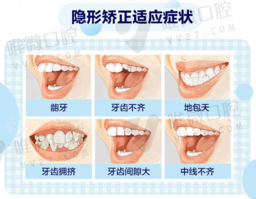 牙贴面跟牙冠有什么区别（过小牙做贴面好还是烤瓷牙）(图1)